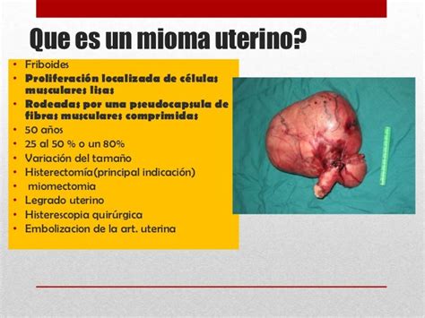 Tumores benignos de utero... by adilene & alexis