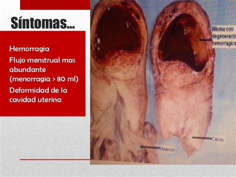 Tumores benignos de utero... by adilene & alexis