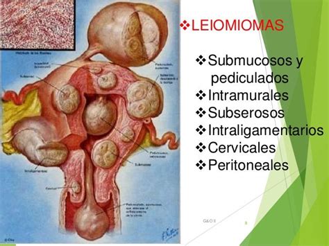 Tumores benignos de útero, leimiomas, fibromas, endometriosis y adeno…