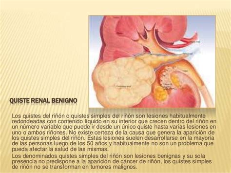 Tumores benignos del riñón