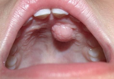 Tumores benignos en la cavidad oral Dentisalut