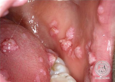 Tumores benignos en la cavidad oral   Dentisalut