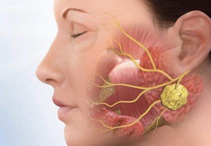 Tumores benignos en las glándulas salivales: síntomas y características ...
