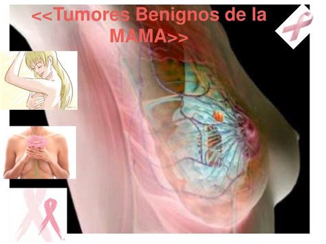 Tumores Benignos Mama   SEONegativo.com