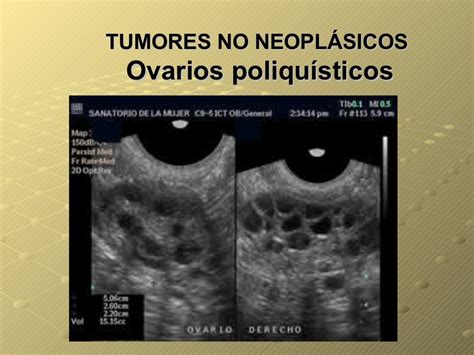 Tumores benignos ovario