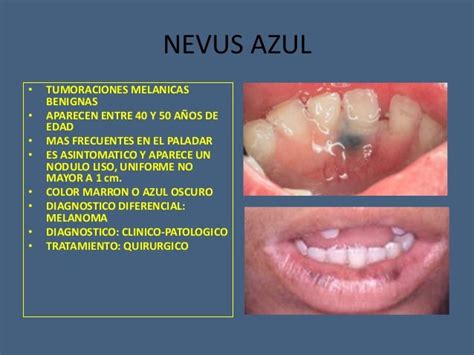 Tumores benignos y malignos de cavidad oral