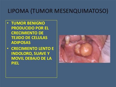 Tumores benignos y malignos de cavidad oral