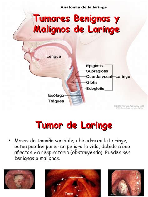 Tumores Benignos y Malignos de Laringe | Metástasis | Laringe