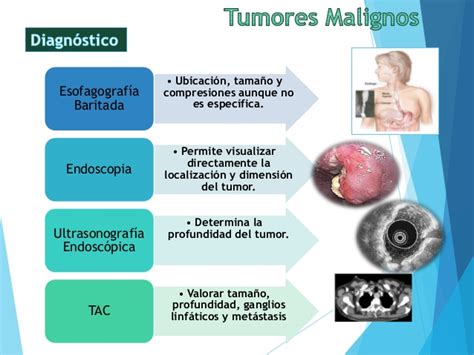 Tumores benignos y malignos esofágicos, divertículos