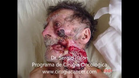 Tumores Cabeza y Cuello Dr Sergio Ralon   YouTube