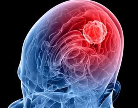 Tumores cerebrais | neurototal.com