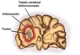 Tumores cerebrales   3.000 casos más al año en España