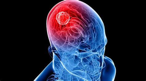 Tumores cerebrales alteran la actividad de neuronas ...