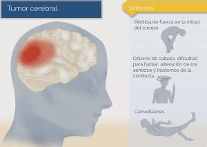 Tumores cerebrales benignos: qué son y cómo se tratan ...