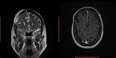 Tumores cerebrales | Blogs Quirónsalud
