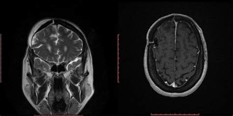 Tumores cerebrales | Blogs Quirónsalud