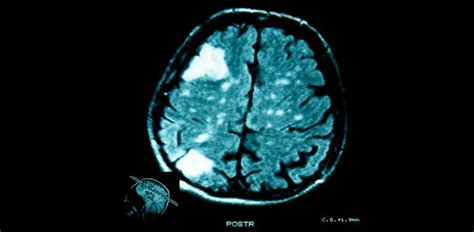 Tumores cerebrales Causas, síntomas y tratamiento