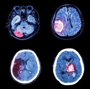 Tumores cerebrales   Doctor Oscar González Oncólogo y ...