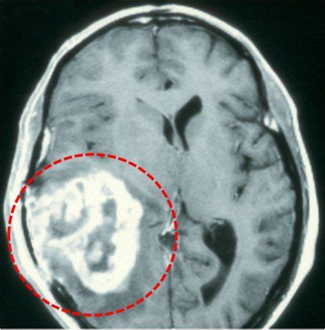 Tumores Cerebrales en Adultos | Tumor cerebral, Cerebral ...