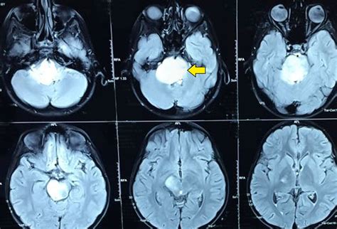 Tumores cerebrales infantiles: la imagen importa