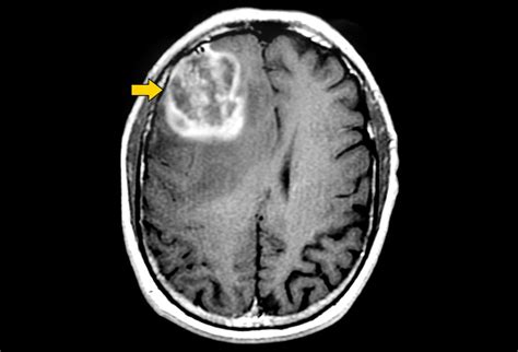 Tumores cerebrales infantiles: la imagen importa