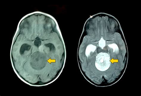 Tumores cerebrales infantiles: la imagen importa