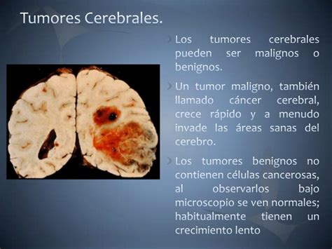 Tumores cerebrales