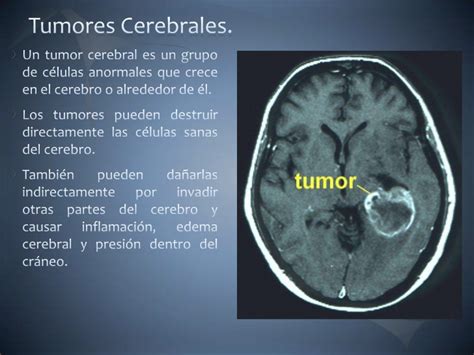Tumores cerebrales