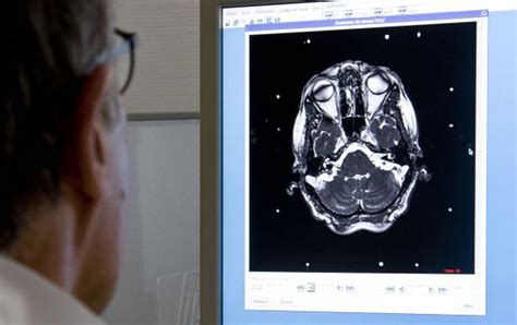 Tumores cerebrales no tan benignos | Sociedad | EL PAÍS
