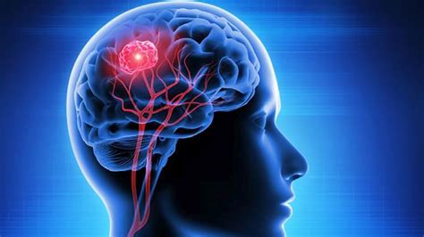 Tumores cerebrales síntomas e información en CuidatePlus