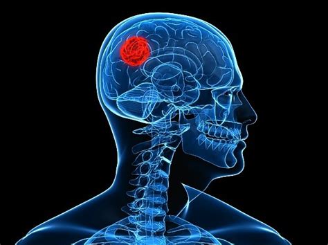 Tumores cerebrales: son mortales, pero aparecen con menos ...