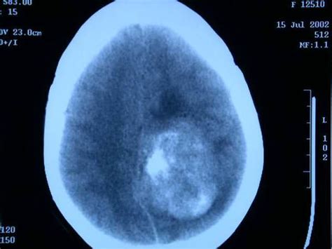 Tumores Cerebrales | Unidad de Neurocirugía RGS