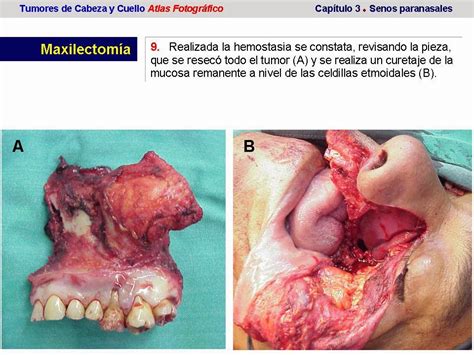 Tumores de Cabeza y Cuello Atlas Fotográfico: Tumores de ...
