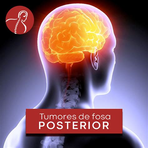 Tumores de fosa posterior