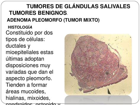 Tumores de glandulas salivales.