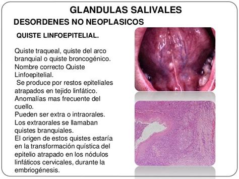 Tumores de glandulas salivales.
