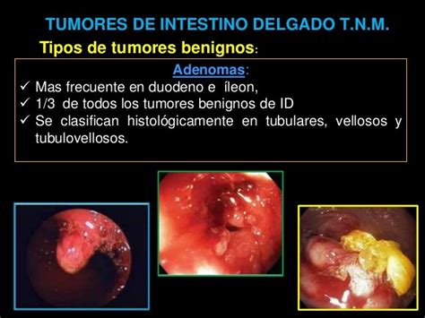 Tumores de intestino delgado tnm. ekipo 6 2