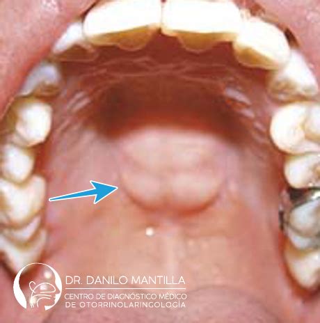 Tumores de la boca | Dr. Danilo Mantilla ORL | Diagnóstico ...