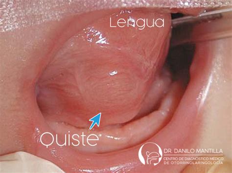 Tumores de la boca | Dr. Danilo Mantilla ORL | Diagnóstico y ...