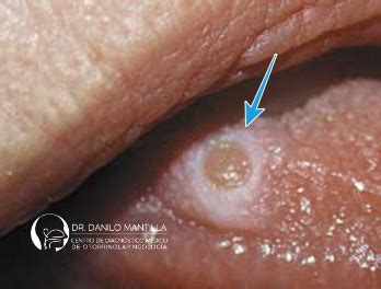 Tumores de la boca | Dr. Danilo Mantilla ORL | Diagnóstico y ...