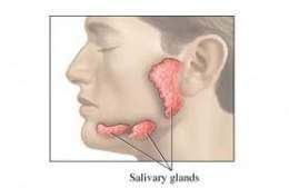 Tumores de las glándulas salivales   EcuRed