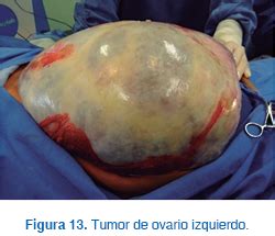 Tumores de ovario de la granulosa: Informe de casos y ...
