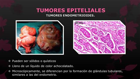 Tumores de ovario