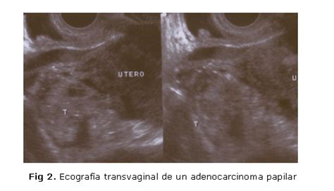 Tumores de ovario: patogenia, cuadro clínico, diagnóstico ...