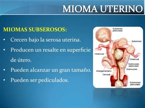 Tumores del cuerpo uterino jonathan molina