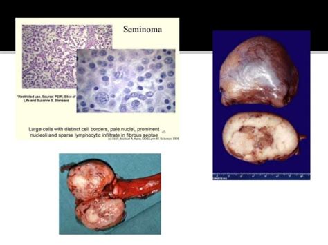 Tumores del testículo