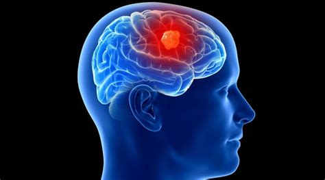 Tumores en el cerebro | Anatomía Patológica