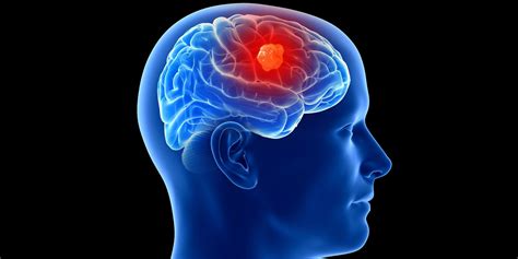 Tumores en el cerebro | Anatomía Patológica