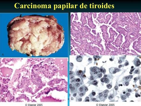 Tumores endocrinos