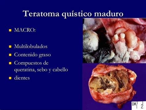Tumores germinales ovaricos